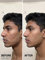 Before and after comparison of a man's cheek showing visibly reduced breakouts and clearer skin after using PROWL Acne Control Face Serum.